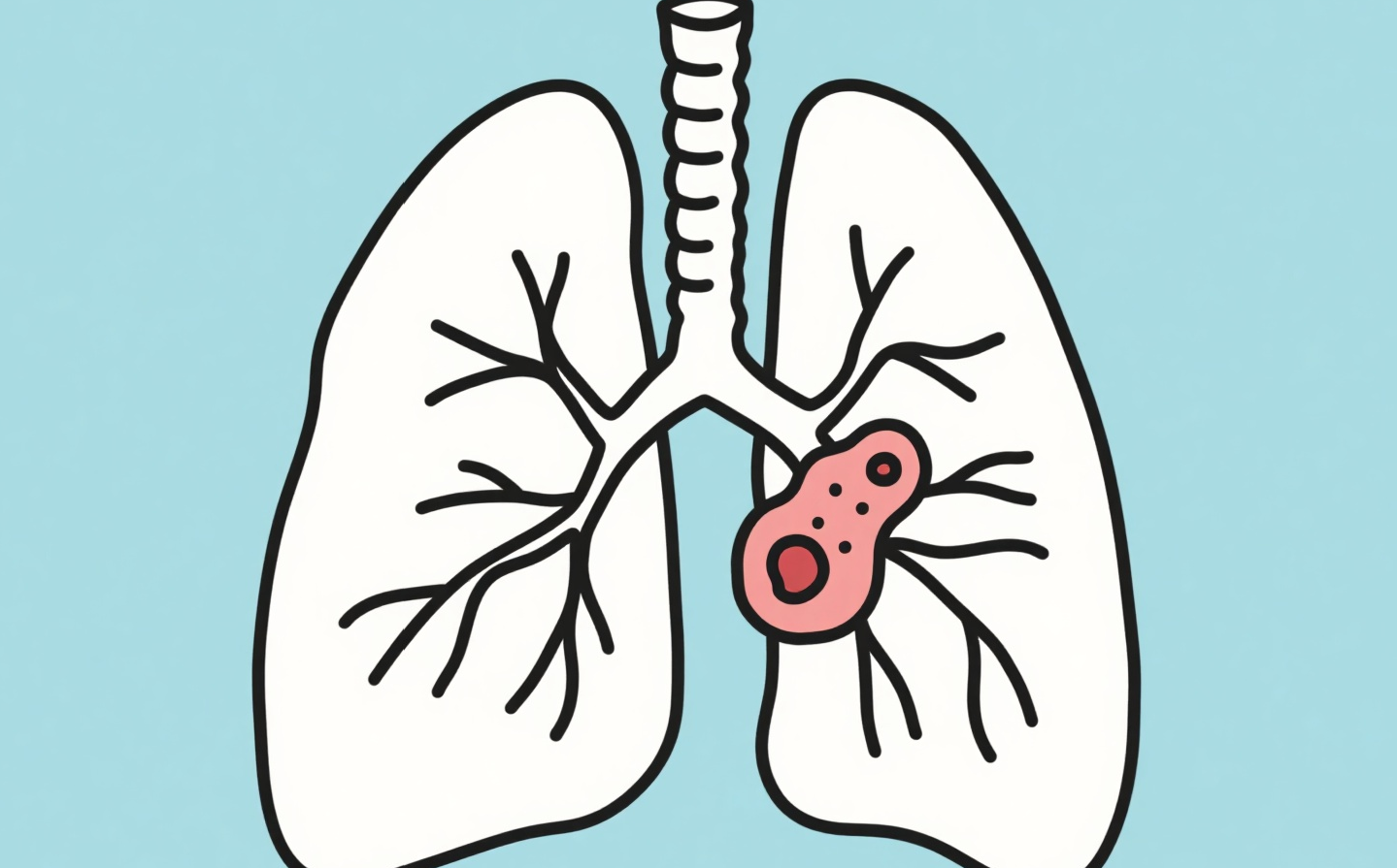 得了肺结节咳嗽