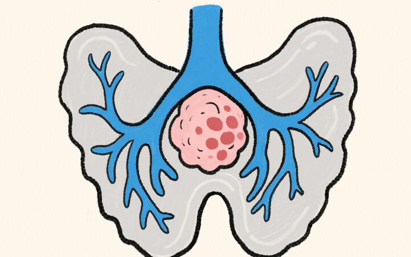 得了甲状腺结节怎么办