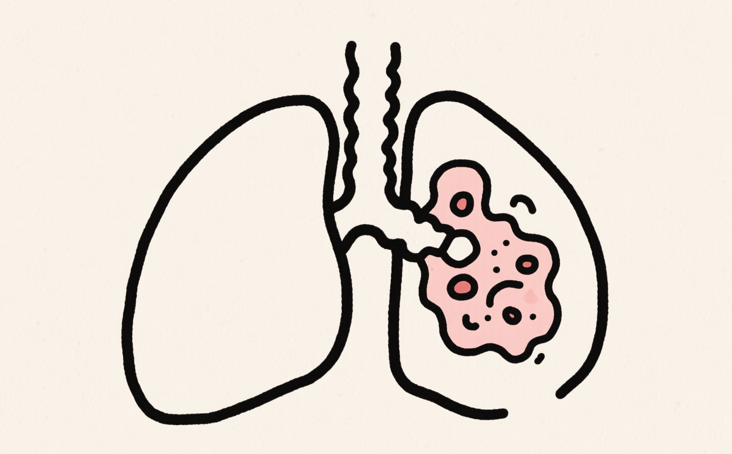 肺癌患者平时怎么吃
